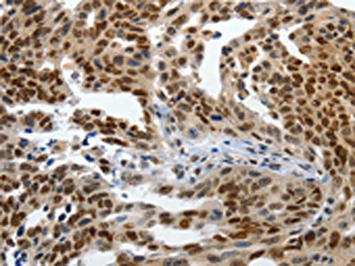 The image on the left is immunohistochemistry of paraffin-embedded Human ovarian cancer tissue using the antibody Antibody) at dilution 1/120, on the right is treated with synthetic peptide. (Original magnification: ×200)