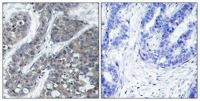 Immunohistochemical analysis of paraffin-embedded human breast carcinoma tissue using Pyk2(Ab-402) Antibody(left) or the same antibody preincubated with blocking peptide(right).Rabbit anti-Human PTK2B Polyclonal Antibody