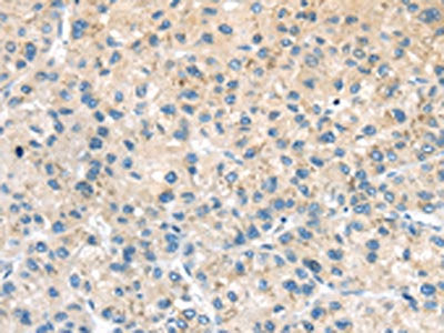 The image on the left is immunohistochemistry of paraffin-embedded Human liver cancer tissue using the antibody Antibody) at dilution 1/20, on the right is treated with synthetic peptide. (Original magnification: ×200)