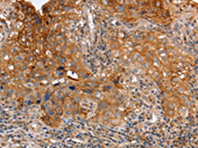 The image on the left is immunohistochemistry of paraffin-embedded Human cervical cancer tissue using PLAUR Antibody(PLAUR Antibody) at dilution 1/60, on the right is treated with fusion protein. (Original magnification: ×200)Rabbit anti-Human PLAUR Polyclonal Antibody