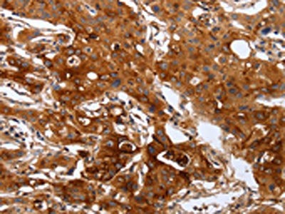 The image on the left is immunohistochemistry of paraffin-embedded Human lung cancer tissue using the antibody Antibody) at dilution 1/60, on the right is treated with fusion protein. (Original magnification: ×200)Rabbit anti-Human PLAUR Polyclonal Antibody