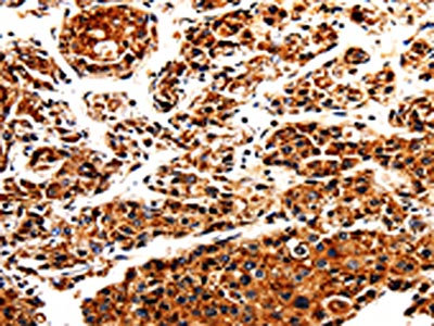 The image is immunohistochemistry of paraffin-embedded Human liver cancer tissue using APLP1 Antibody(APLP1 Antibody) at dilution 1/25. (Original magnification: ×200)Rabbit anti-Human APLP1 Polyclonal Antibody