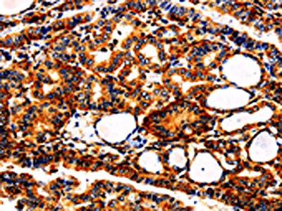 The image is immunohistochemistry of paraffin-embedded Human thyroid cancer tissue using the antibody Antibody) at dilution 1/25. (Original magnification: ×200)Rabbit anti-Human APLP1 Polyclonal Antibody