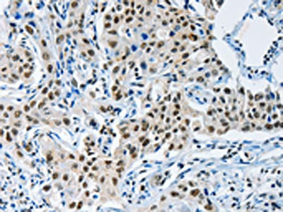 The image on the left is immunohistochemistry of paraffin-embedded Human lung cancer tissue using KDM1A Antibody(KDM1A Antibody) at dilution 1/55, on the right is treated with synthetic peptide. (Original magnification: ×200)