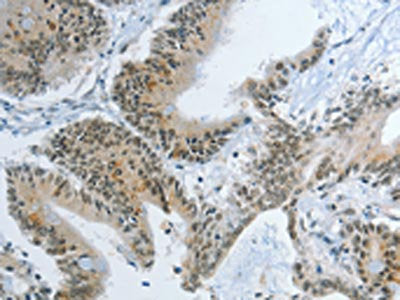 The image on the left is immunohistochemistry of paraffin-embedded Human colon cancer tissue using the antibody Antibody) at dilution 1/55, on the right is treated with synthetic peptide. (Original magnification: ×200)