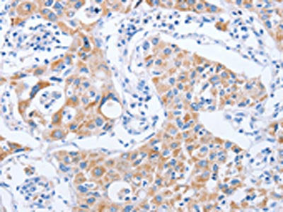 The image on the left is immunohistochemistry of paraffin-embedded Human lung cancer tissue using KIF3A Antibody(KIF3A Antibody) at dilution 1/25, on the right is treated with fusion protein. (Original magnification: ×200)