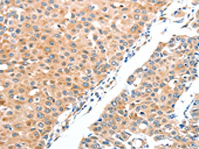 The image on the left is immunohistochemistry of paraffin-embedded Human breast cancer tissue using ADAM2 Antibody(ADAM2 Antibody) at dilution 1/20, on the right is treated with fusion protein. (Original magnification: ×200)Rabbit anti-Human ADAM2 Polyclonal Antibody