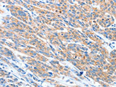The image on the left is immunohistochemistry of paraffin-embedded Human esophagus cancer tissue using the antibody Antibody) at dilution 1/20, on the right is treated with fusion protein. (Original magnification: ×200)