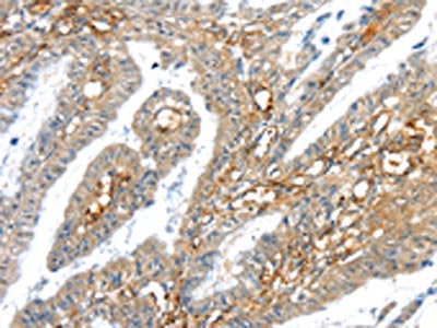 The image on the left is immunohistochemistry of paraffin-embedded Human esophagus cancer tissue using TRIM47 Antibody(TRIM47 Antibody) at dilution 1/30, on the right is treated with synthetic peptide. (Original magnification: ×200)Rabbit anti-Human TRIM47 Polyclonal Antibody