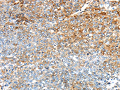 The image on the left is immunohistochemistry of paraffin-embedded Human ovarian cancer tissue using the antibody Antibody) at dilution 1/30, on the right is treated with synthetic peptide. (Original magnification: ×200)Rabbit anti-Human TRIM47 Polyclonal Antibody