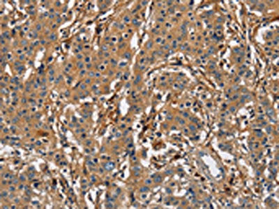 The image on the left is immunohistochemistry of paraffin-embedded Human gastric cancer tissue using BLK Antibody(BLK Antibody) at dilution 1/20, on the right is treated with fusion protein. (Original magnification: ×200)