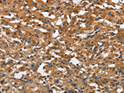 The image on the left is immunohistochemistry of paraffin-embedded Human thyroid cancer tissue using the antibody Antibody) at dilution 1/20, on the right is treated with fusion protein. (Original magnification: ×200)