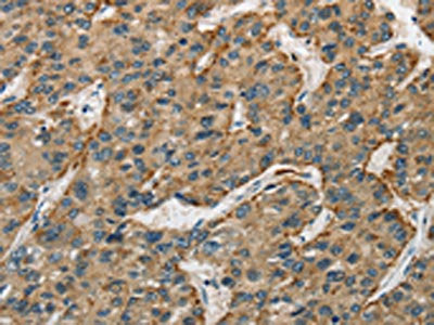The image on the left is immunohistochemistry of paraffin-embedded Human liver cancer tissue using CTSE Antibody(CTSE Antibody) at dilution 1/50, on the right is treated with fusion protein. (Original magnification: ×200)Rabbit anti-Human CTSE Polyclonal Antibody