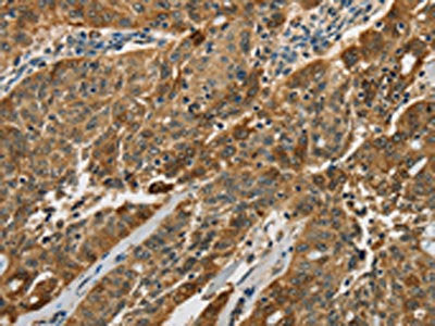 The image on the left is immunohistochemistry of paraffin-embedded Human ovarian cancer tissue using the antibody Antibody) at dilution 1/50, on the right is treated with fusion protein. (Original magnification: ×200)Rabbit anti-Human CTSE Polyclonal Antibody