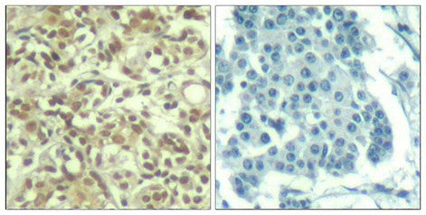 Immunohistochemical analysis of paraffin-embedded human breast carcinoma tissue using AKT1(Phospho-Thr450) Antibody(left) or the same antibody preincubated with blocking peptide(right).Rabbit anti-Human AKT1 Polyclonal Antibody