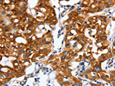 The image on the left is immunohistochemistry of paraffin-embedded Human lung cancer tissue using CLDND1 Antibody(CLDND1 Antibody) at dilution 1/60, on the right is treated with synthetic peptide. (Original magnification: ×200)Rabbit anti-Human CLDND1 Polyclonal Antibody