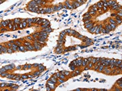 The image on the left is immunohistochemistry of paraffin-embedded Human colon cancer tissue using the antibody Antibody) at dilution 1/60, on the right is treated with synthetic peptide. (Original magnification: ×200)Rabbit anti-Human CLDND1 Polyclonal Antibody