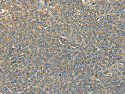 The image on the left is immunohistochemistry of paraffin-embedded Human ovarian cancer tissue using DHCR24 Antibody(DHCR24 Antibody) at dilution 1/40, on the right is treated with fusion protein. (Original magnification: ×200)Rabbit anti-Human DHCR24 Polyclonal Antibody