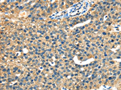 The image on the left is immunohistochemistry of paraffin-embedded Human breast cancer tissue using the antibody Antibody) at dilution 1/40, on the right is treated with fusion protein. (Original magnification: ×200)Rabbit anti-Human DHCR24 Polyclonal Antibody