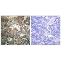 Immunohistochemistry analysis of paraffin-embedded human breast carcinoma tissue using XPA antibody.Rabbit anti-Human XPA Polyclonal Antibody