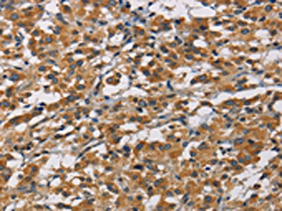 The image on the left is immunohistochemistry of paraffin-embedded Human thyroid cancer tissue using ICAM1 Antibody(ICAM1 Antibody) at dilution 1/40, on the right is treated with fusion protein. (Original magnification: ×200)Rabbit anti-Human ICAM1 Polyclonal Antibody