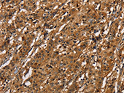 The image on the left is immunohistochemistry of paraffin-embedded Human gastic cancer tissue using the antibody Antibody) at dilution 1/40, on the right is treated with fusion protein. (Original magnification: ×200)Rabbit anti-Human ICAM1 Polyclonal Antibody