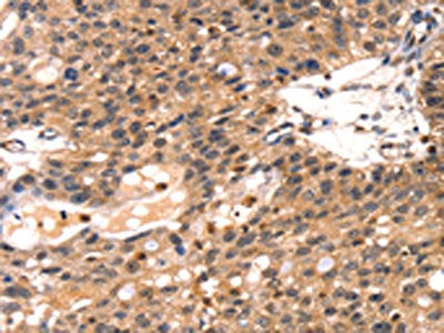 The image on the left is immunohistochemistry of paraffin-embedded Human breast cancer tissue using TLN1 Antibody(TLN1 Antibody) at dilution 1/35, on the right is treated with synthetic peptide. (Original magnification: ×200)Rabbit anti-Human TLN1 Polyclonal Antibody