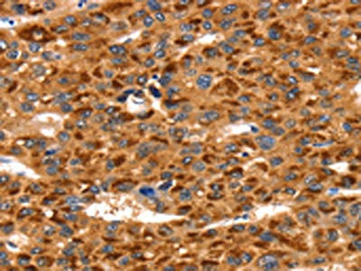 The image on the left is immunohistochemistry of paraffin-embedded Human liver cancer tissue using the antibody Antibody) at dilution 1/35, on the right is treated with synthetic peptide. (Original magnification: ×200)Rabbit anti-Human TLN1 Polyclonal Antibody