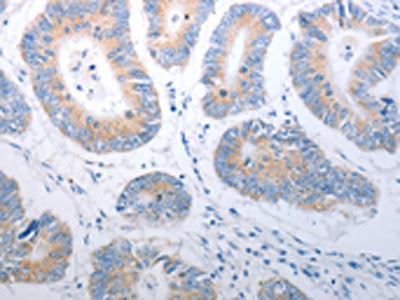 The image on the left is immunohistochemistry of paraffin-embedded Human colon cancer tissue using PAK1 Antibody(PAK1 Antibody) at dilution 1/40, on the right is treated with synthetic peptide. (Original magnification: ×200)Rabbit anti-Human PAK1 Polyclonal Antibody