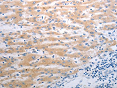 The image on the left is immunohistochemistry of paraffin-embedded Human liver cancer tissue using the antibody Antibody) at dilution 1/40, on the right is treated with synthetic peptide. (Original magnification: ×200)Rabbit anti-Human PAK1 Polyclonal Antibody