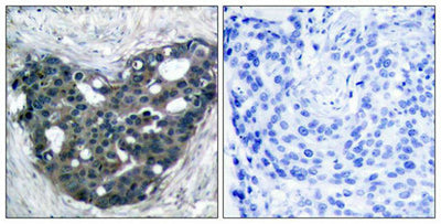 Immunohistochemical analysis of paraffin-embedded human breast carcinoma tissue using p56Dok-2(Ab-299) Antibody(left) or the same antibody preincubated with blocking peptide(right).Rabbit anti-Human DOK2 Polyclonal Antibody