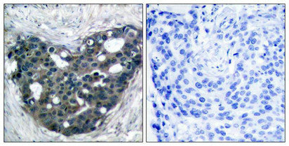 Immunohistochemical analysis of paraffin-embedded human breast carcinoma tissue using p56Dok-2(Ab-299) Antibody(left) or the same antibody preincubated with blocking peptide(right).Rabbit anti-Human DOK2 Polyclonal Antibody