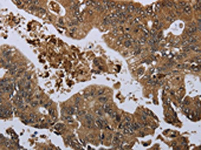 The image on the left is immunohistochemistry of paraffin-embedded Human colon cancer tissue using GP1BA Antibody(GP1BA Antibody) at dilution 1/60, on the right is treated with fusion protein. (Original magnification: ×200)Rabbit anti-Human GP1BA Polyclonal Antibody