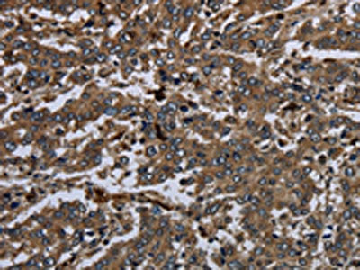 The image on the left is immunohistochemistry of paraffin-embedded Human liver cancer tissue using the antibody Antibody) at dilution 1/60, on the right is treated with fusion protein. (Original magnification: ×200)Rabbit anti-Human GP1BA Polyclonal Antibody