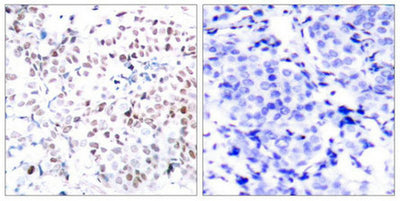 Immunohistochemical analysis of paraffin-embedded human breast carcinoma tissue using Myc(Phospho-Thr358) Antibody(left) or the same antibody preincubated with blocking peptide(right).Rabbit anti-Human MYC Polyclonal Antibody