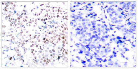 Immunohistochemical analysis of paraffin-embedded human breast carcinoma tissue using Myc(Phospho-Thr358) Antibody(left) or the same antibody preincubated with blocking peptide(right).Rabbit anti-Human MYC Polyclonal Antibody