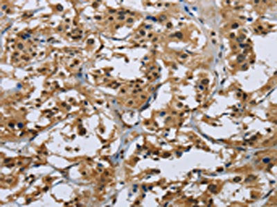 The image on the left is immunohistochemistry of paraffin-embedded Human thyroid cancer tissue using IL31 Antibody(IL31 Antibody) at dilution 1/20, on the right is treated with synthetic peptide. (Original magnification: ×200)Rabbit anti-Human IL31 Polyclonal Antibody
