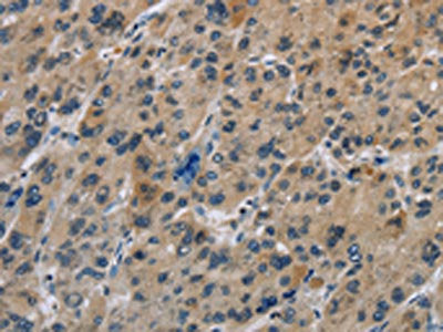 The image on the left is immunohistochemistry of paraffin-embedded Human liver cancer tissue using the antibody Antibody) at dilution 1/20, on the right is treated with synthetic peptide. (Original magnification: ×200)Rabbit anti-Human IL31 Polyclonal Antibody