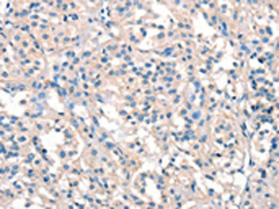 The image on the left is immunohistochemistry of paraffin-embedded Human thyroid cancer tissue using ARHGEF11 Antibody(ARHGEF11 Antibody) at dilution 1/25, on the right is treated with synthetic peptide. (Original magnification: ×200)Rabbit anti-Human ARHGEF11 Polyclonal Antibody