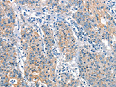 The image on the left is immunohistochemistry of paraffin-embedded Human gastic cancer tissue using the antibody Antibody) at dilution 1/25, on the right is treated with synthetic peptide. (Original magnification: ×200)Rabbit anti-Human ARHGEF11 Polyclonal Antibody
