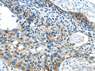 The image on the left is immunohistochemistry of paraffin-embedded Human esophagus cancer tissue using VAMP1 Antibody(VAMP1 Antibody) at dilution 1/35, on the right is treated with synthetic peptide. (Original magnification: ×200)Rabbit anti-Human VAMP1 Polyclonal Antibody