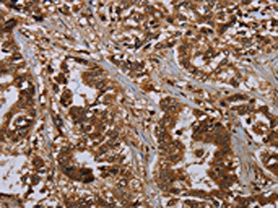 The image on the left is immunohistochemistry of paraffin-embedded Human liver cancer tissue using MOB1A Antibody(MOB1A Antibody) at dilution 1/20, on the right is treated with synthetic peptide. (Original magnification: ×200)Rabbit anti-Human MOB1A Polyclonal Antibody
