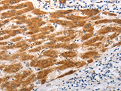The image on the left is immunohistochemistry of paraffin-embedded Human liver cancer tissue using SLC22A8 Antibody(SLC22A8 Antibody) at dilution 1/25, on the right is treated with synthetic peptide. (Original magnification: ×200)Rabbit anti-Human SLC22A8 Polyclonal Antibody