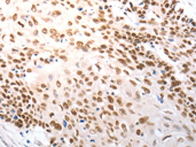 The image on the left is immunohistochemistry of paraffin-embedded Human cervical cancer tissue using the antibody Antibody) at dilution 1/25, on the right is treated with synthetic peptide. (Original magnification: ×200)Rabbit anti-Human SLC22A8 Polyclonal Antibody