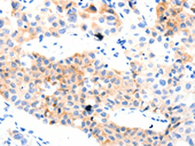 The image on the left is immunohistochemistry of paraffin-embedded Human lung cancer tissue using GPR3 Antibody(GPR3  Antibody) at dilution 1/55, on the right is treated with synthetic peptide. (Original magnification: ×200)Rabbit anti-Human GPR3 Polyclonal Antibody