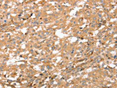 The image on the left is immunohistochemistry of paraffin-embedded Human thyroid cancer tissue using the antibody Antibody) at dilution 1/60, on the right is treated with fusion protein. (Original magnification: ×200)Rabbit anti-Human AHSG Polyclonal Antibody