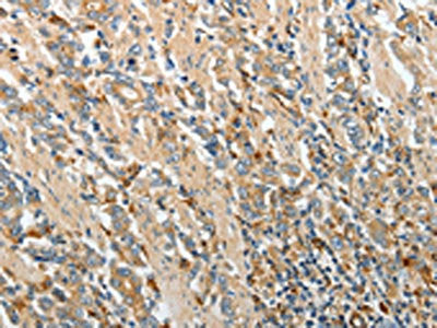 The image on the left is immunohistochemistry of paraffin-embedded Human gastric cancer tissue using PRCP Antibody(PRCP Antibody) at dilution 1/20, on the right is treated with fusion protein. (Original magnification: ×200)Rabbit anti-Human PRCP Polyclonal Antibody