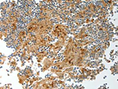 The image on the left is immunohistochemistry of paraffin-embedded Human tonsil tissue using the antibody Antibody) at dilution 1/20, on the right is treated with fusion protein. (Original magnification: ×200)Rabbit anti-Human PRCP Polyclonal Antibody
