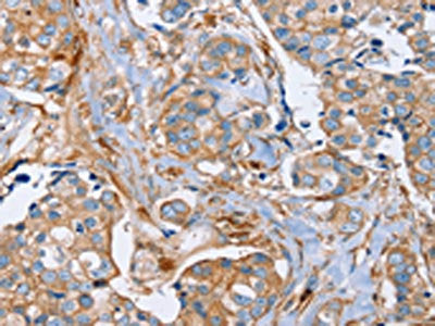 The image on the left is immunohistochemistry of paraffin-embedded Human breast cancer tissue using PLS3 Antibody(PLS3 Antibody) at dilution 1/20, on the right is treated with fusion protein. (Original magnification: ×200)Rabbit anti-Human PLS3 Polyclonal Antibody