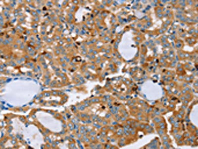 The image on the left is immunohistochemistry of paraffin-embedded Human thyroid cancer tissue using the antibody Antibody) at dilution 1/20, on the right is treated with fusion protein. (Original magnification: ×200)Rabbit anti-Human PLS3 Polyclonal Antibody